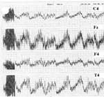 EEG chart of subject introduced to EMR of cellular phone without any protection 